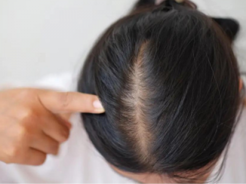 Hairfall Treatment in Lucknow