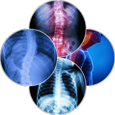 Vertebral Body Tethering (VBT) Surgery in India