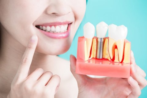Are Dental Implants Covered by Insurance?