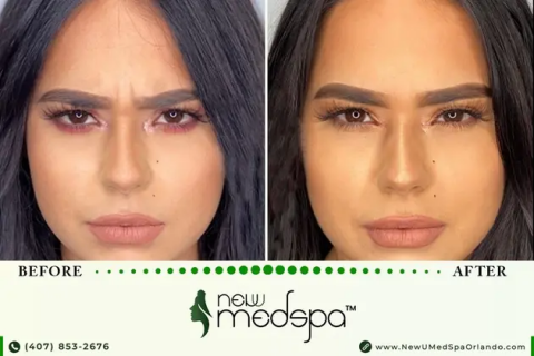 Botox in Orlando