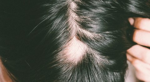 Homeopathic Medicine For Hair Fall In Females
