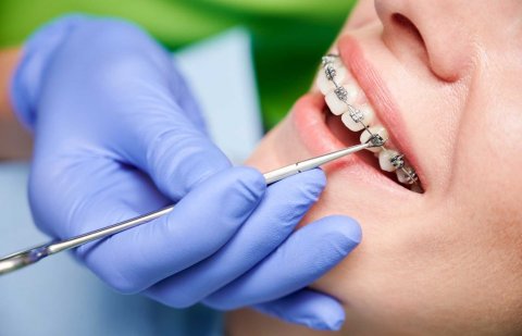 What is Orthodontic Tooth Uncovering ?