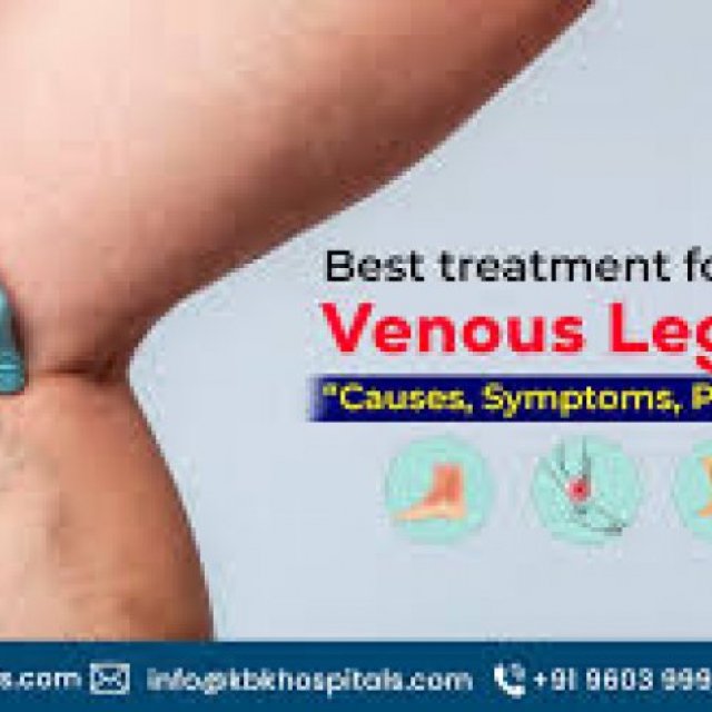 venous ulcer treatment