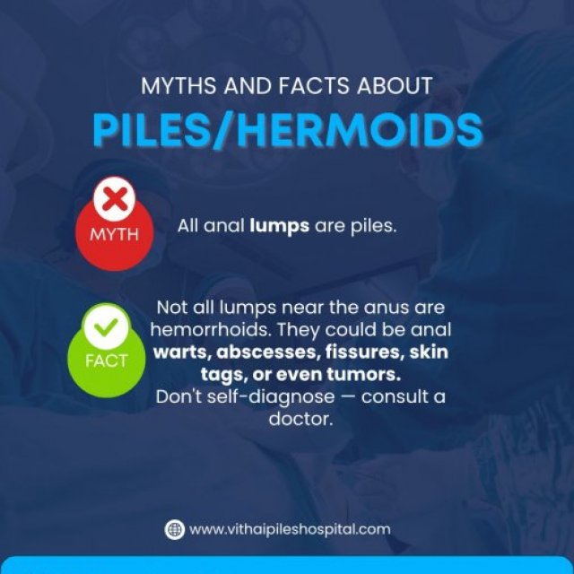 Laser Treatment for Hemorrhoid