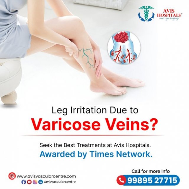 Avis Hospital Varicose Veins Treatment