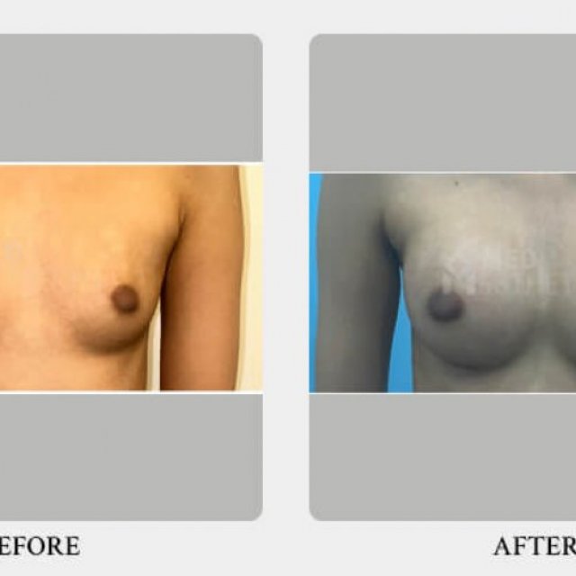 Breast augmentation in delhi