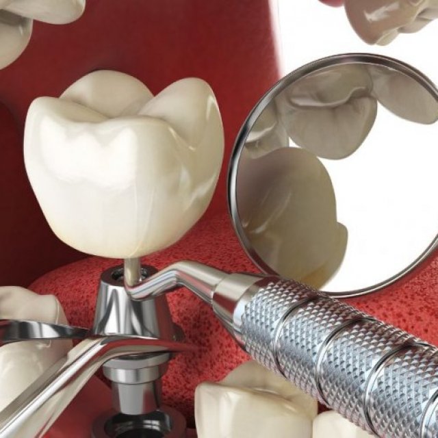 How Dental Implants Can Improve Your Smile and Confidence ?