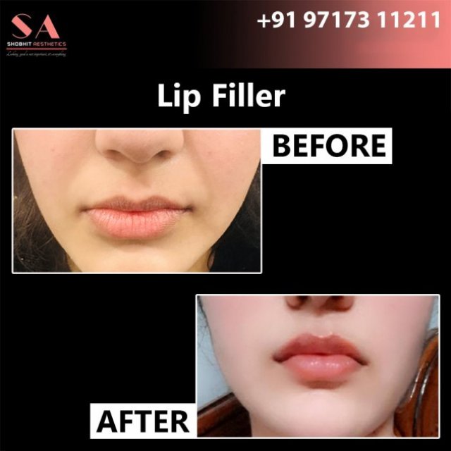 Lip Fillers in Delhi