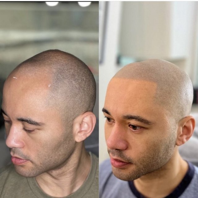 Scalp Micropigmentation in Dubai