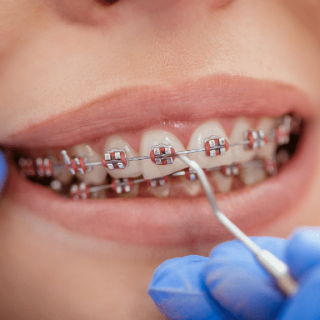 Metal Braces Treatment