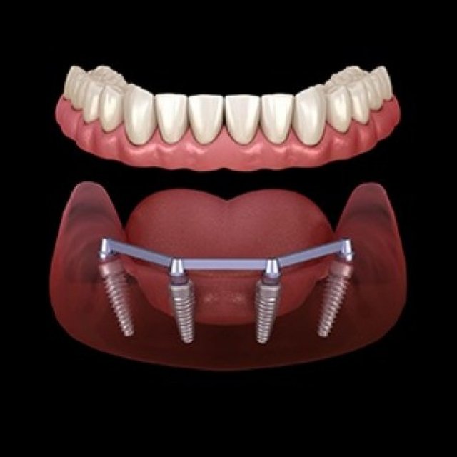 Denta Sculpt