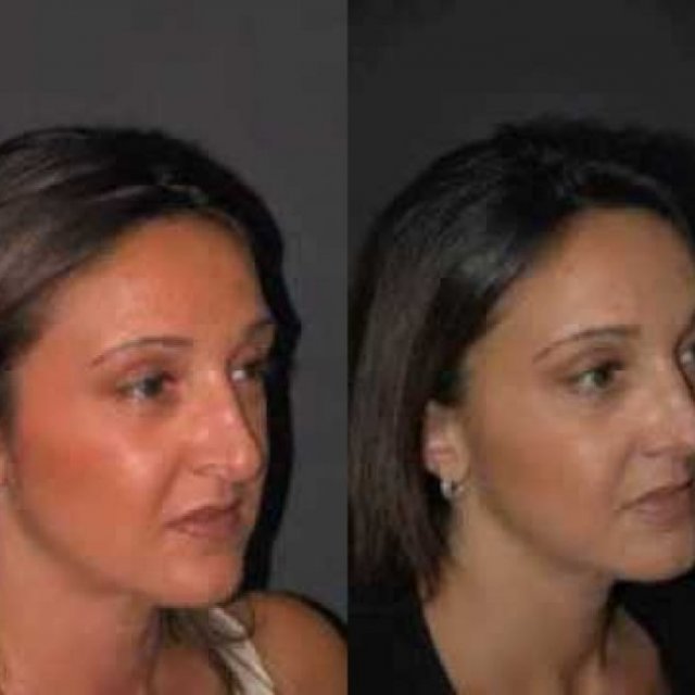 تجميل الأنف