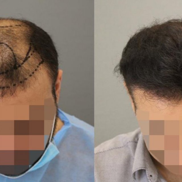 زراعة الشعر في الرياض