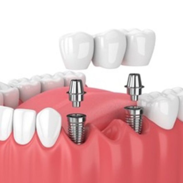Dental implants in karimnagar | Denal clinic in karimnagar