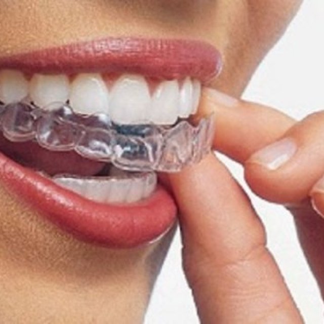 Clear Aligners Treatment in Thane - Agrawal Dental Clinics