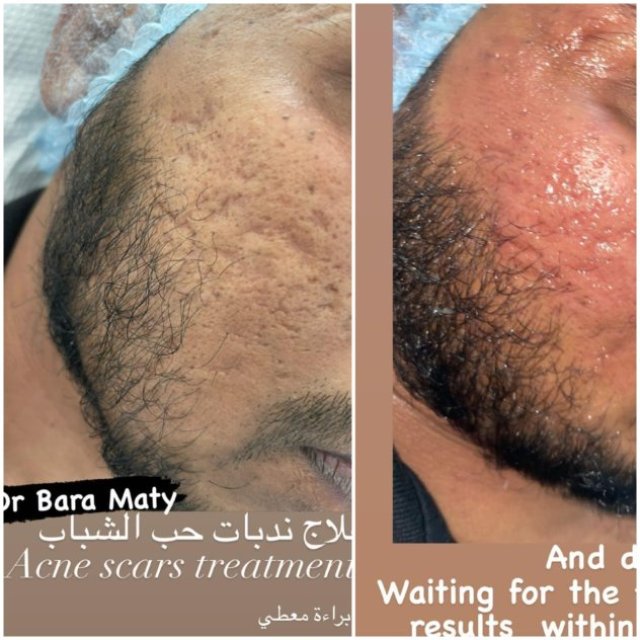 Looking for the best female dermatologist in Dubai? Visit Dr. Bara Maty for expert skincare and transformative results.