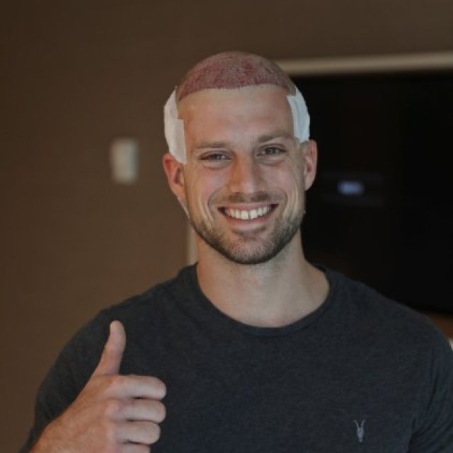 Hair Transplant in Islamabad - Royal Cosmetic Surgery