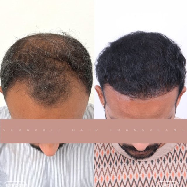 seraphic hair transplant