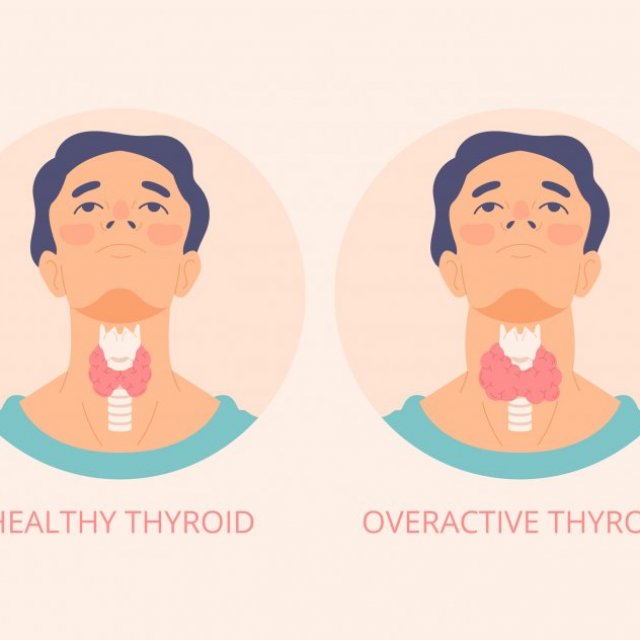 Homeopathy Treatment For Thyroid Disorders