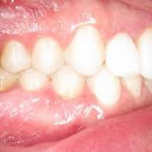 Dental Implants Westminster