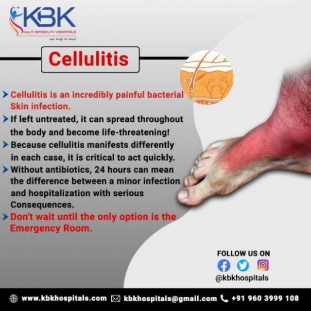 Best Medicine for Cellulitis