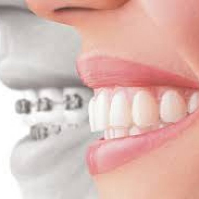 Top Invisalign provider in Dilsukhnagar | Best Invisalign provider in Dilsukhnagar - FMS Dental Clinic