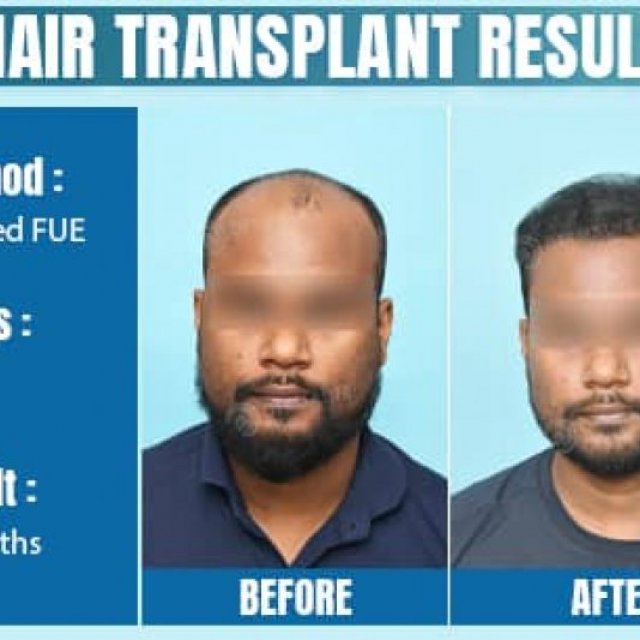 Dermalife - Best Dermatology | Hair Transplant Clinic in Delhi