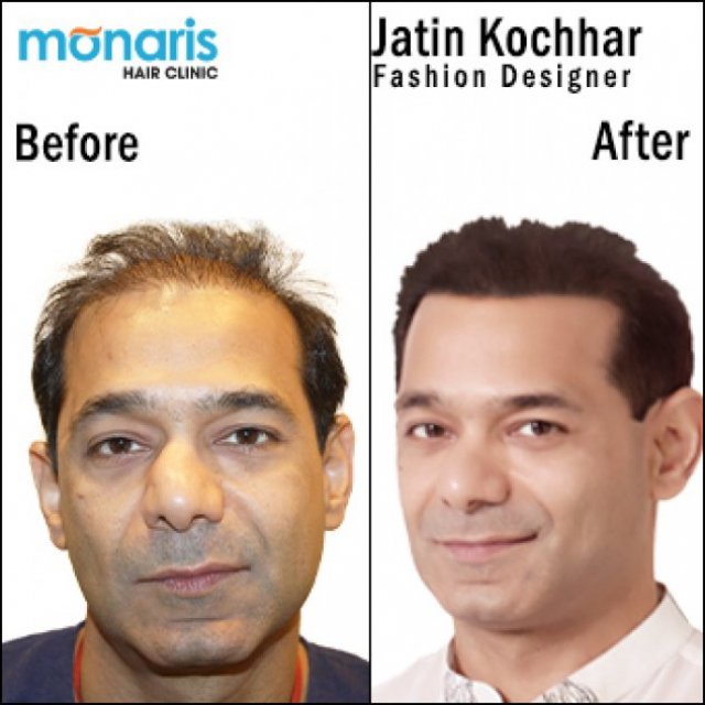 Experience A Completely Pain Free FUE Hair Transplant at Monaris