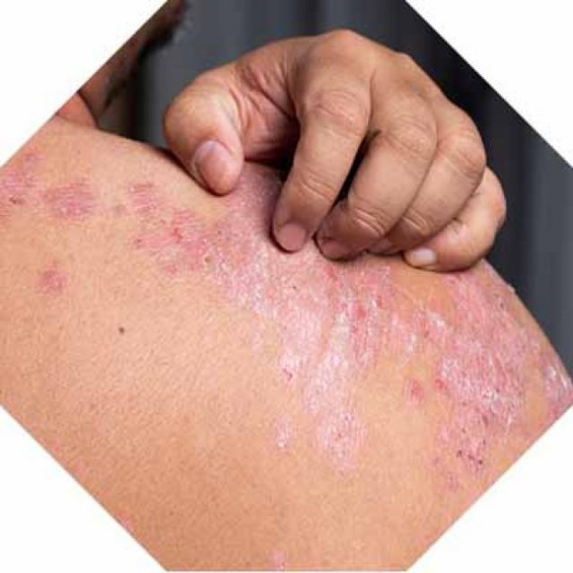 Natural Treatment For Psoriasis