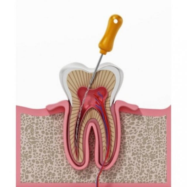 Root Canal Treatment In Gurugram