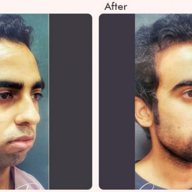 Chin Augmentation Surgery in Delhi - Dr Rajat Gupta