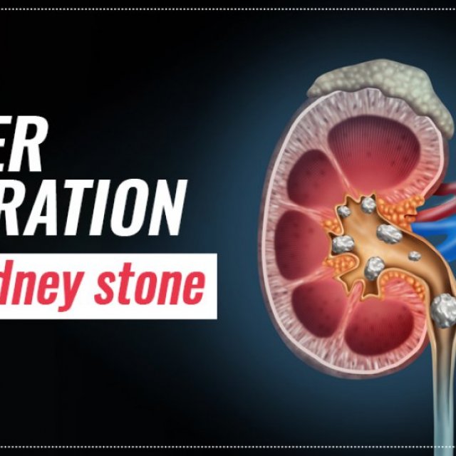 Laser Operation For Kidney Stones In Bangalore | World of Urology