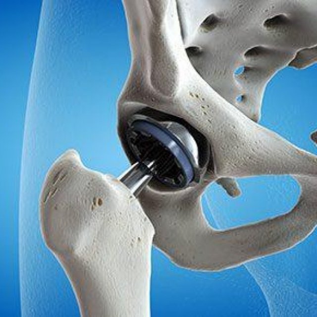 Is Hip Replacement Surgery the Answer to Chronic Hip Pain?