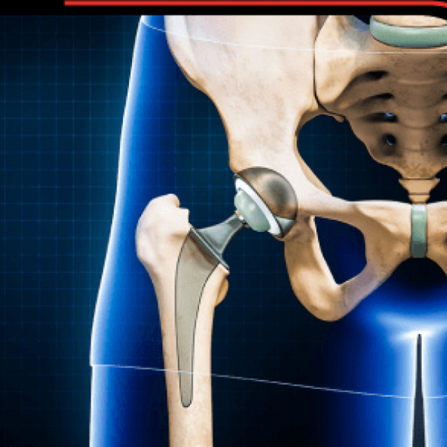 Is It Safe to Exercise After Hip Replacement Surgery?