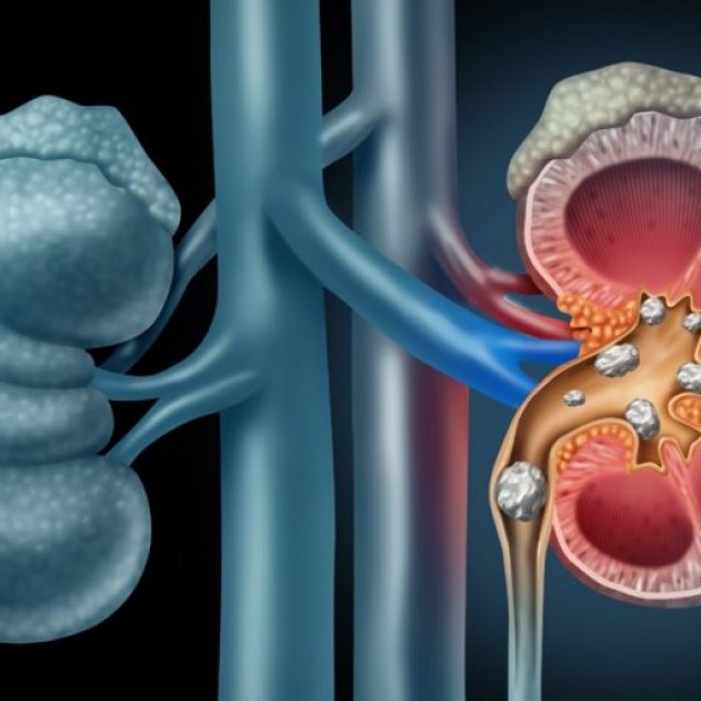 Kidney Stone Treatment in India | Samved Urology Hospital