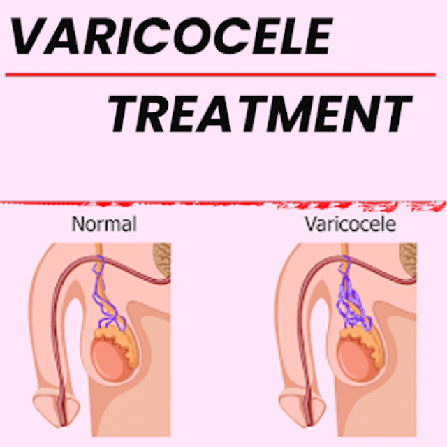 Best Varicocele treatment