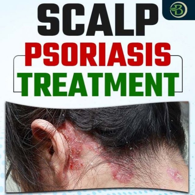 Is There a Permanent Solution for Psoriasis? Find Out Now!