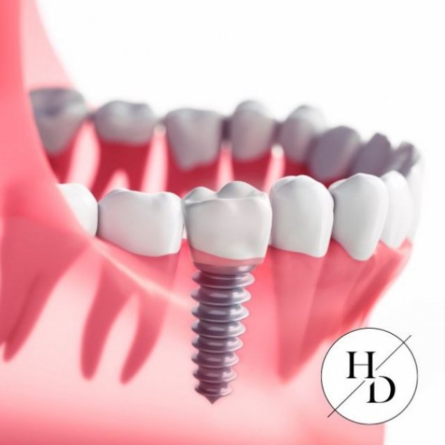 Dental Implants Birmingham - The Ultimate Solution for Missing Teeth!