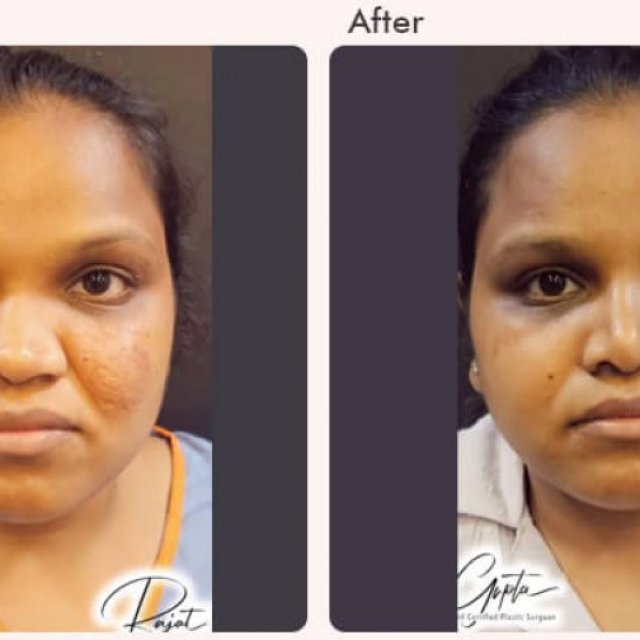 What Is Augmentation Rhinoplasty? All You Need to Know