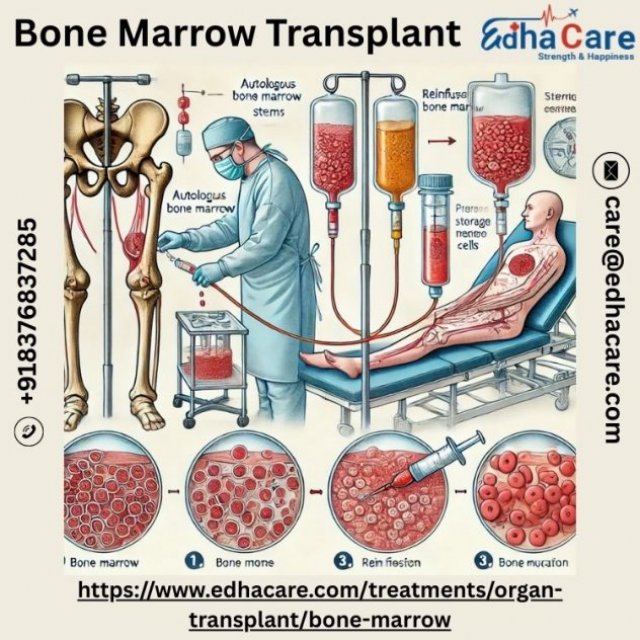 How Many Hours Is Bone Marrow Transplant?