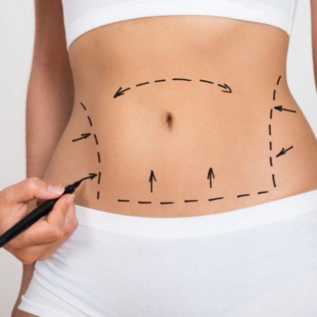 Liposuction Dubai