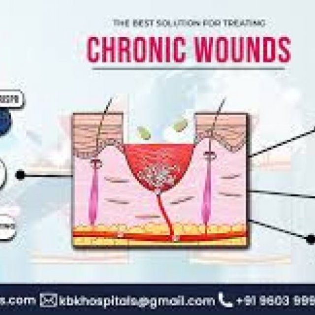 chronic wound management