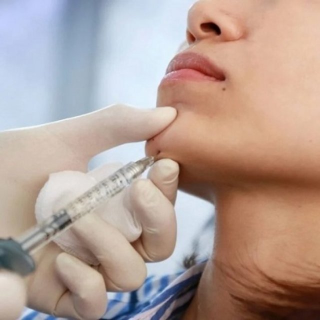 Chin Fillers for Facial Harmony: How They Balance Features