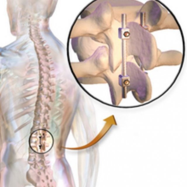Top Minimally Invasive Spine Surgeon Mumbai India