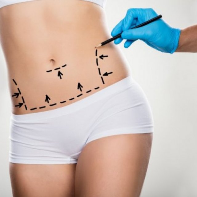 Liposuction Riyadh