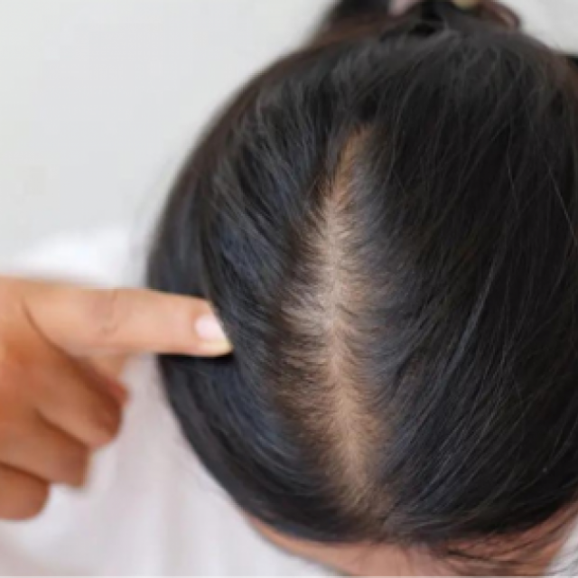 Hairfall Treatment in Lucknow