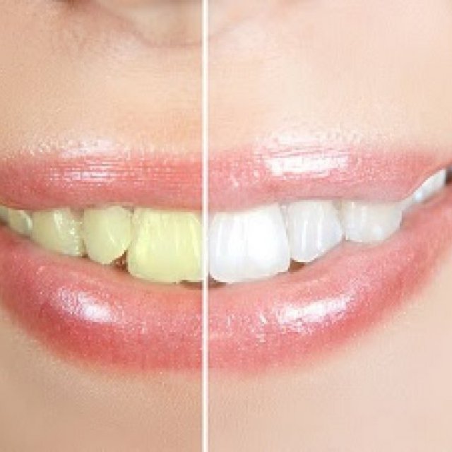 Dental Implants Larchmont