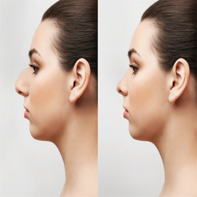 Rhinoplasty in Riyadh