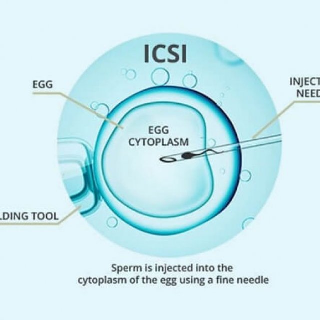icsi treatment cost in delhi - Dr Rhythm Gupta