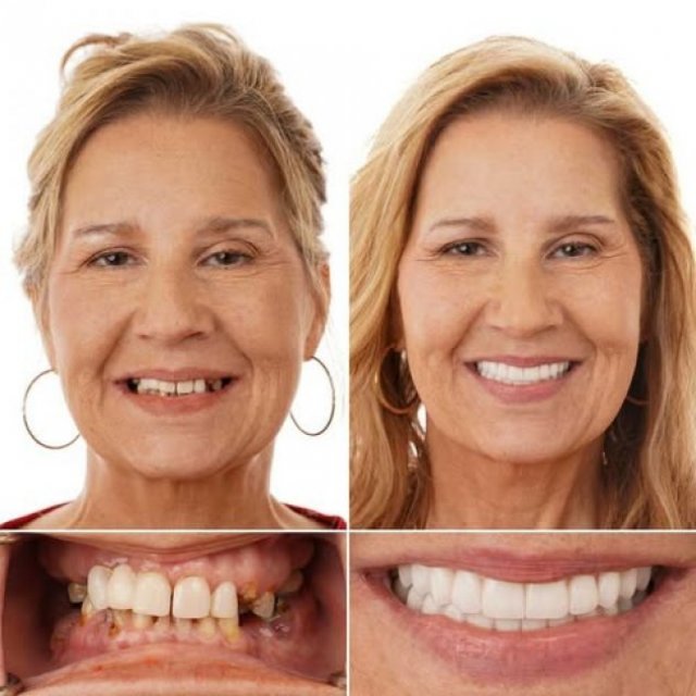 Louisiana Implants and Dentures